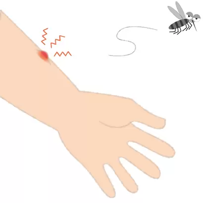 蚊に刺され