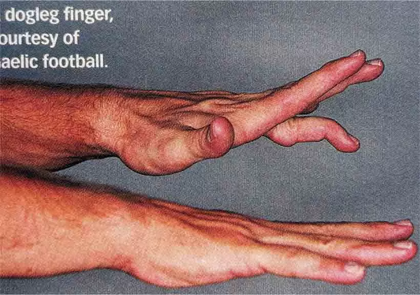 パドレイグ・ハリントン,ドッグレッグ・フィンガー